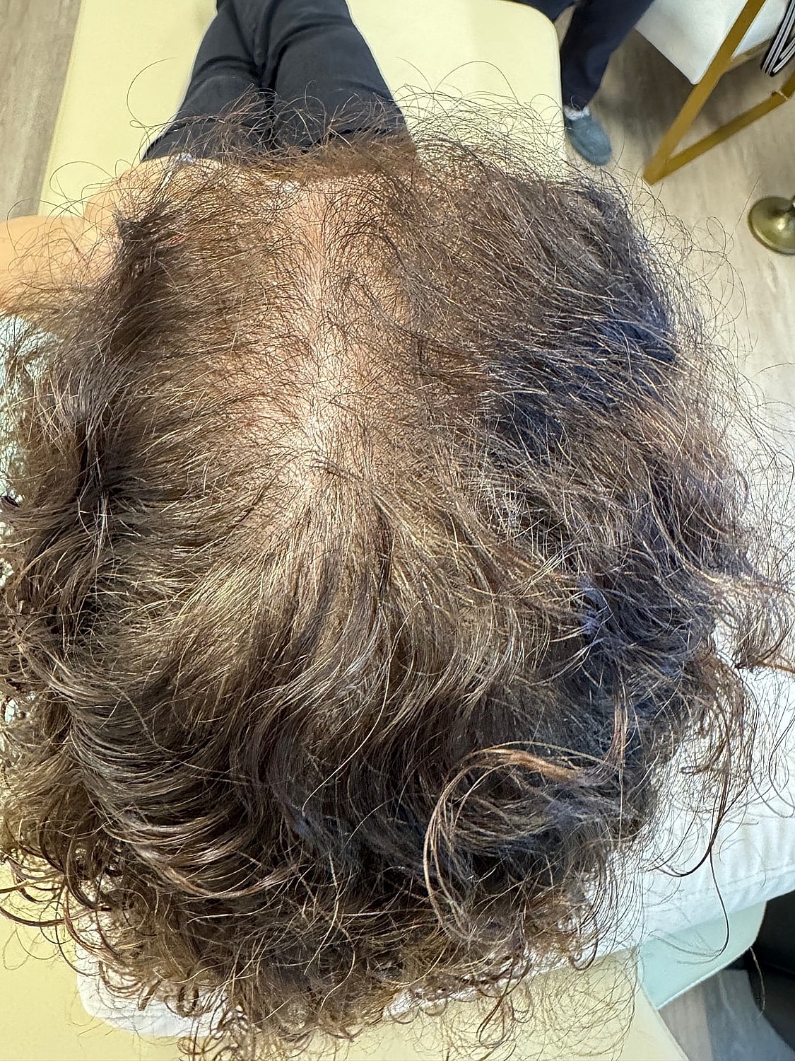 Hair Restoration Gallery Before & After