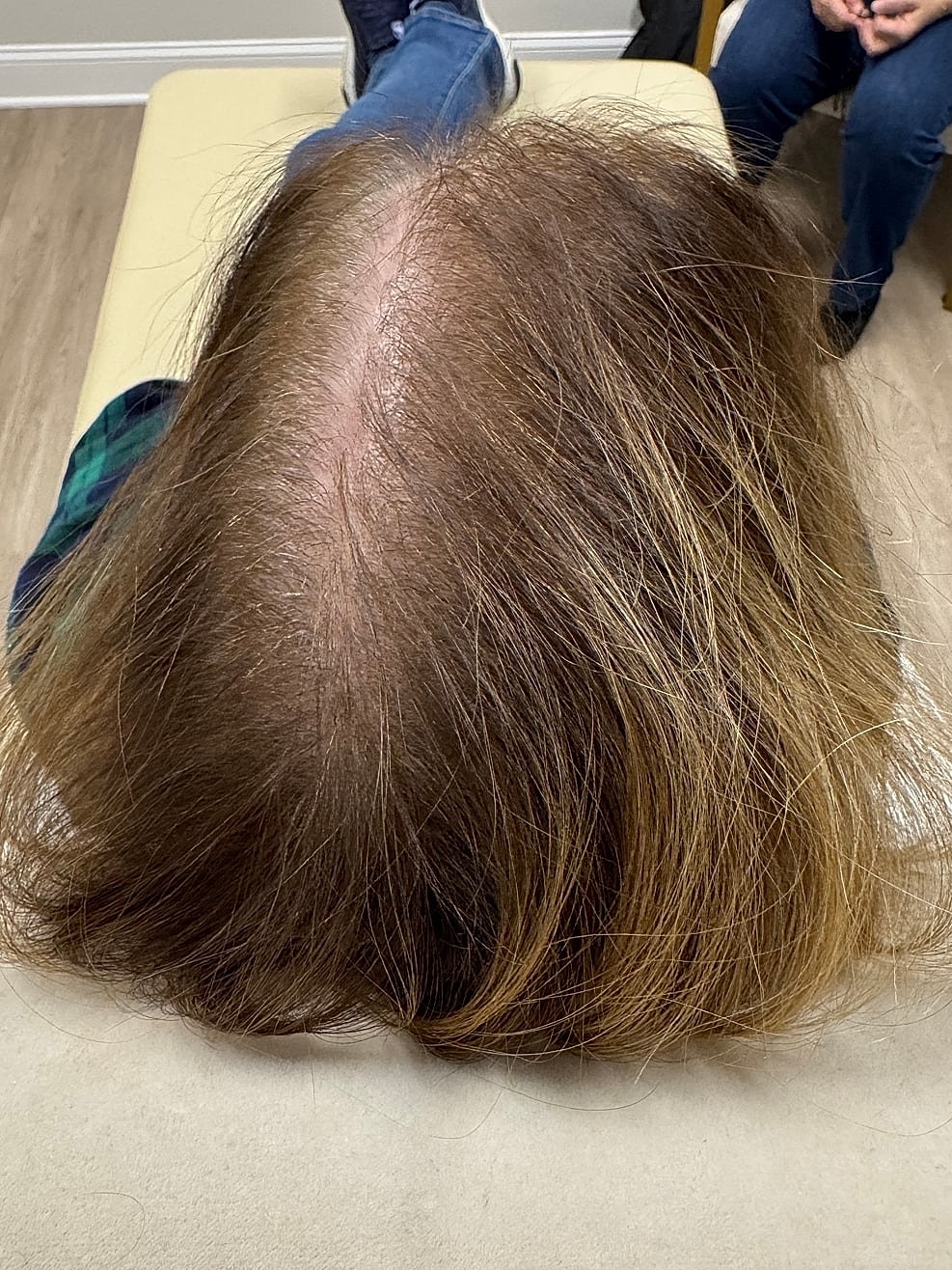 Hair Restoration Gallery Before & After