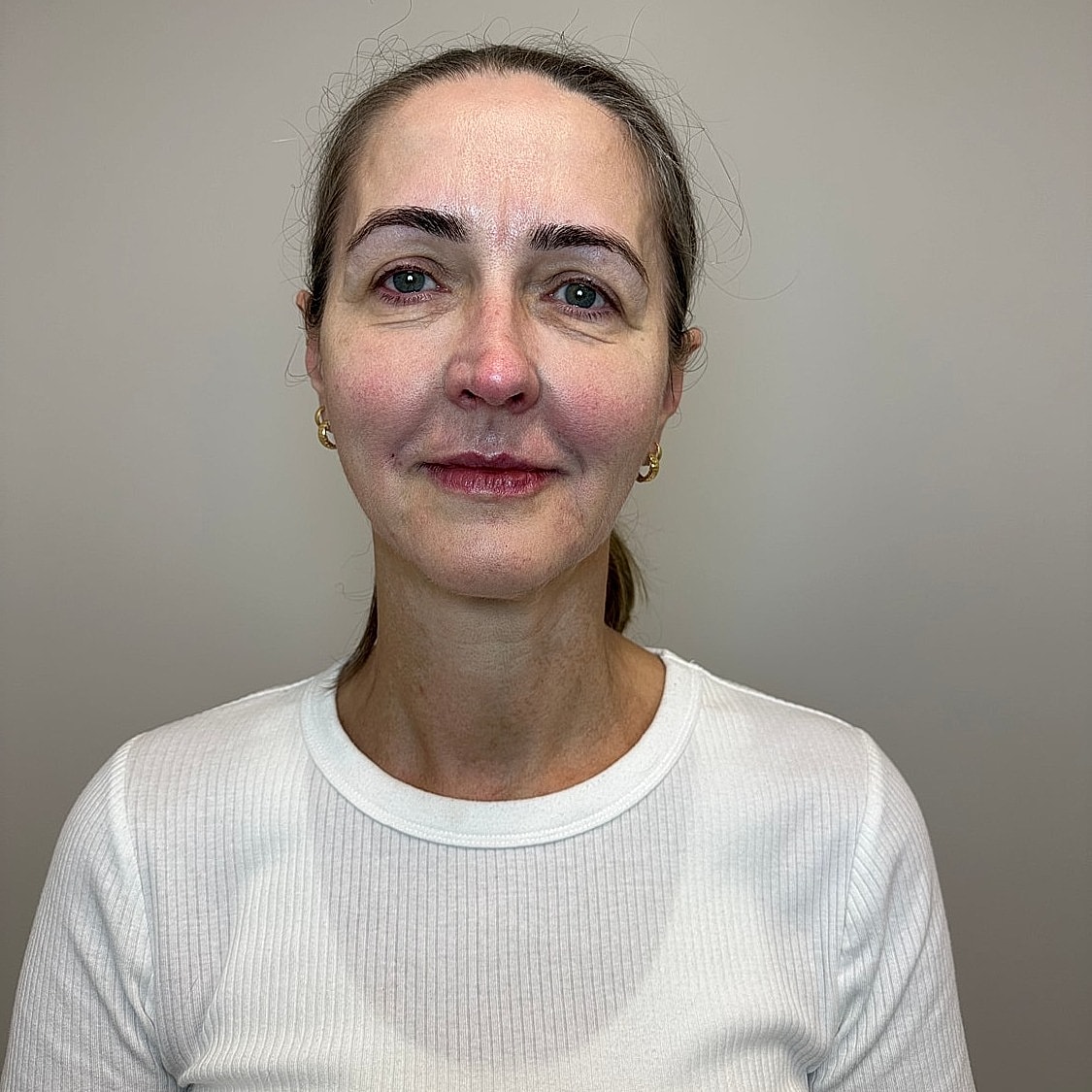 Full Facial Balancing Gallery Before & After