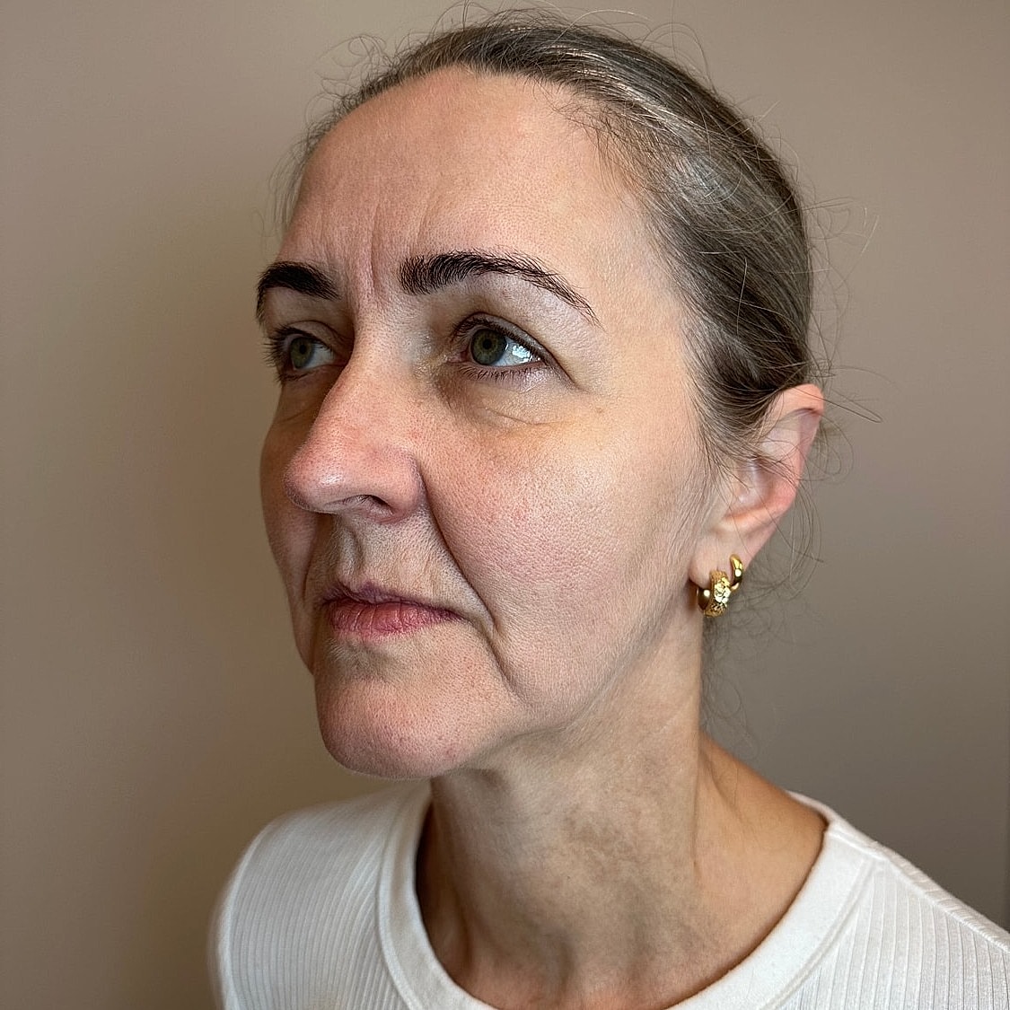 Full Facial Balancing Gallery Before & After