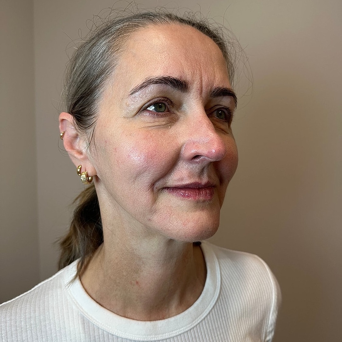 Full Facial Balancing Gallery Before & After