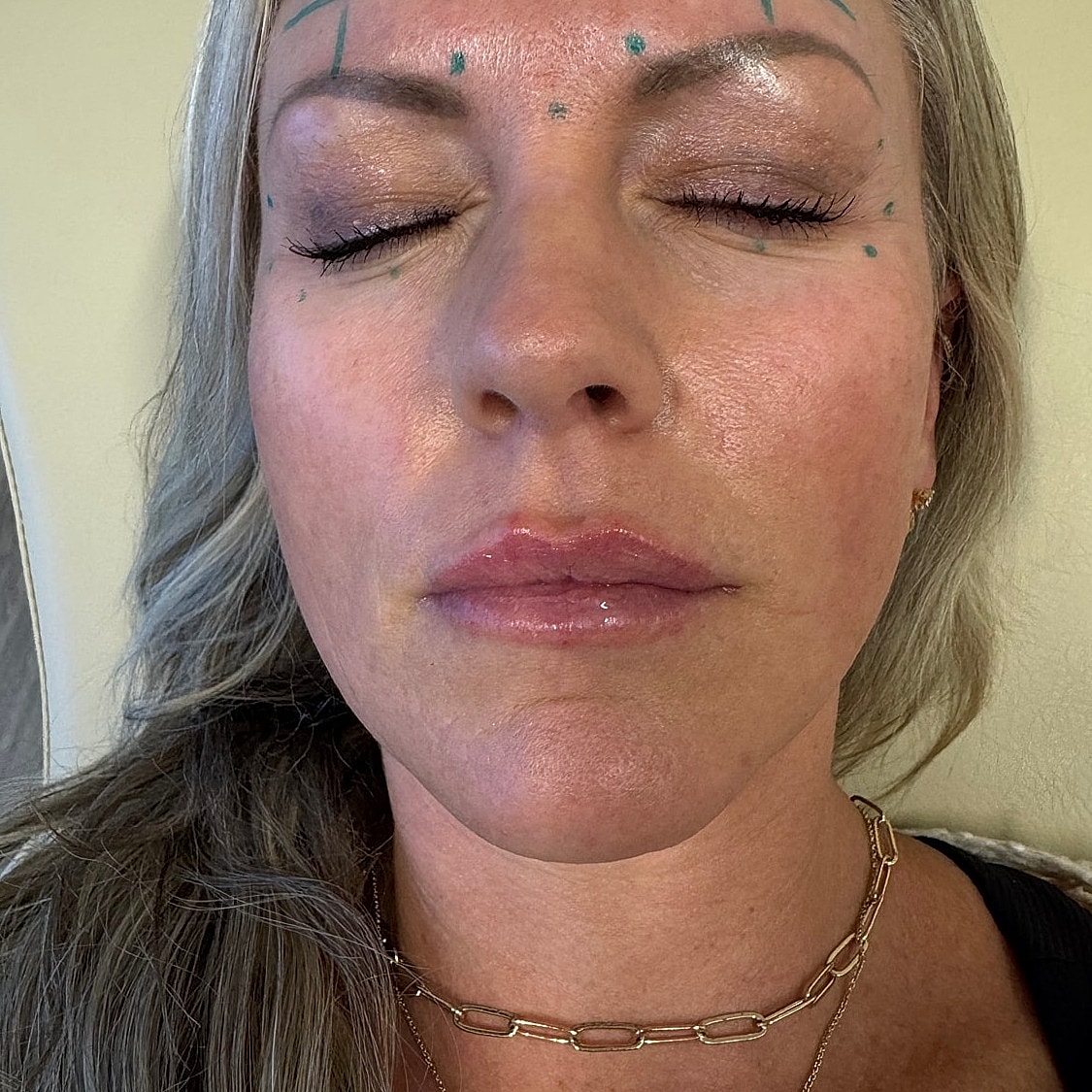 Lip Filler Before & After