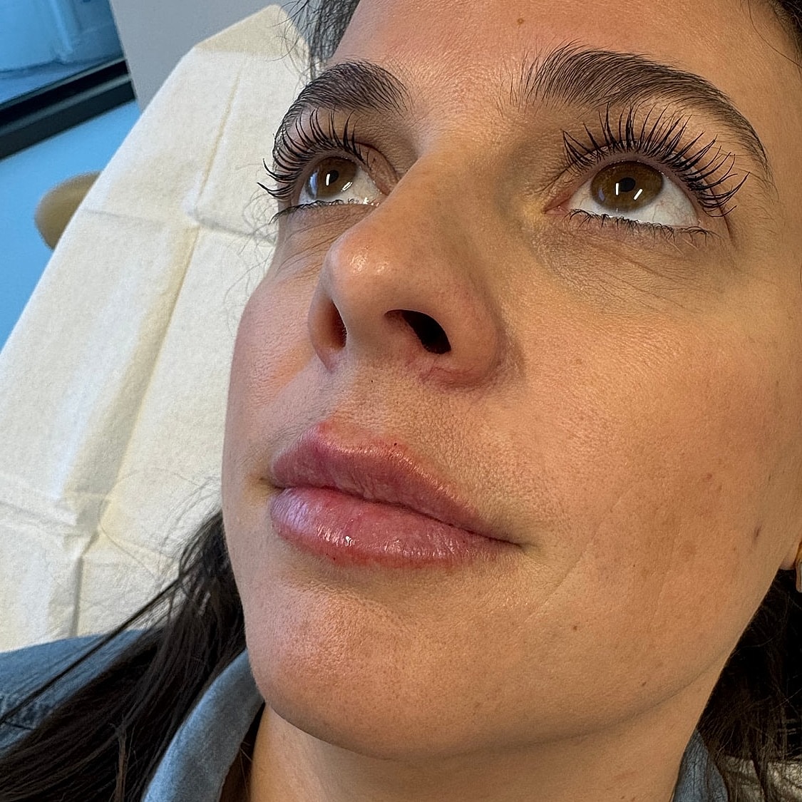 Lip Filler Before & After