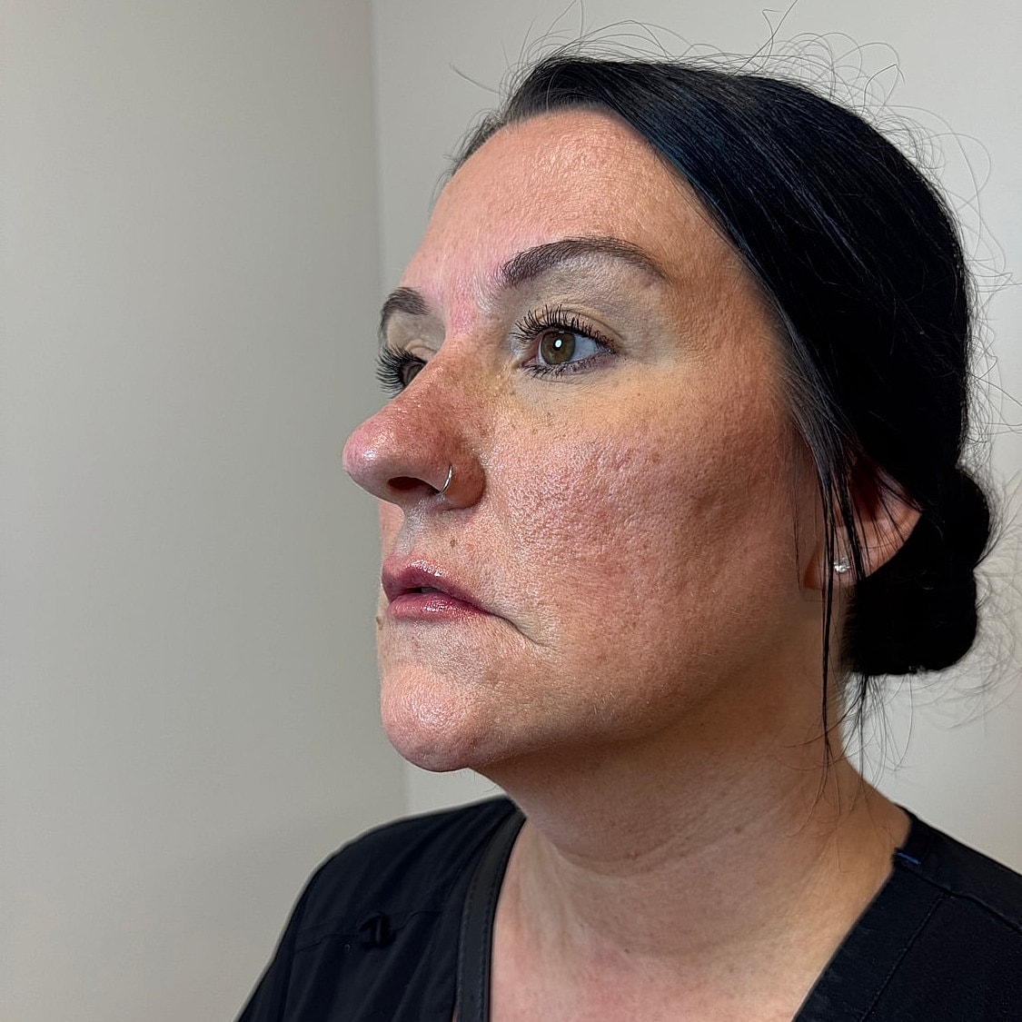 Lip Filler Before & After