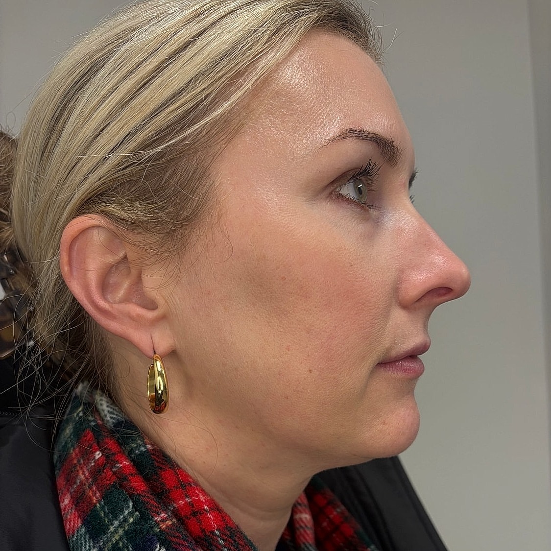 Lip Filler Before & After