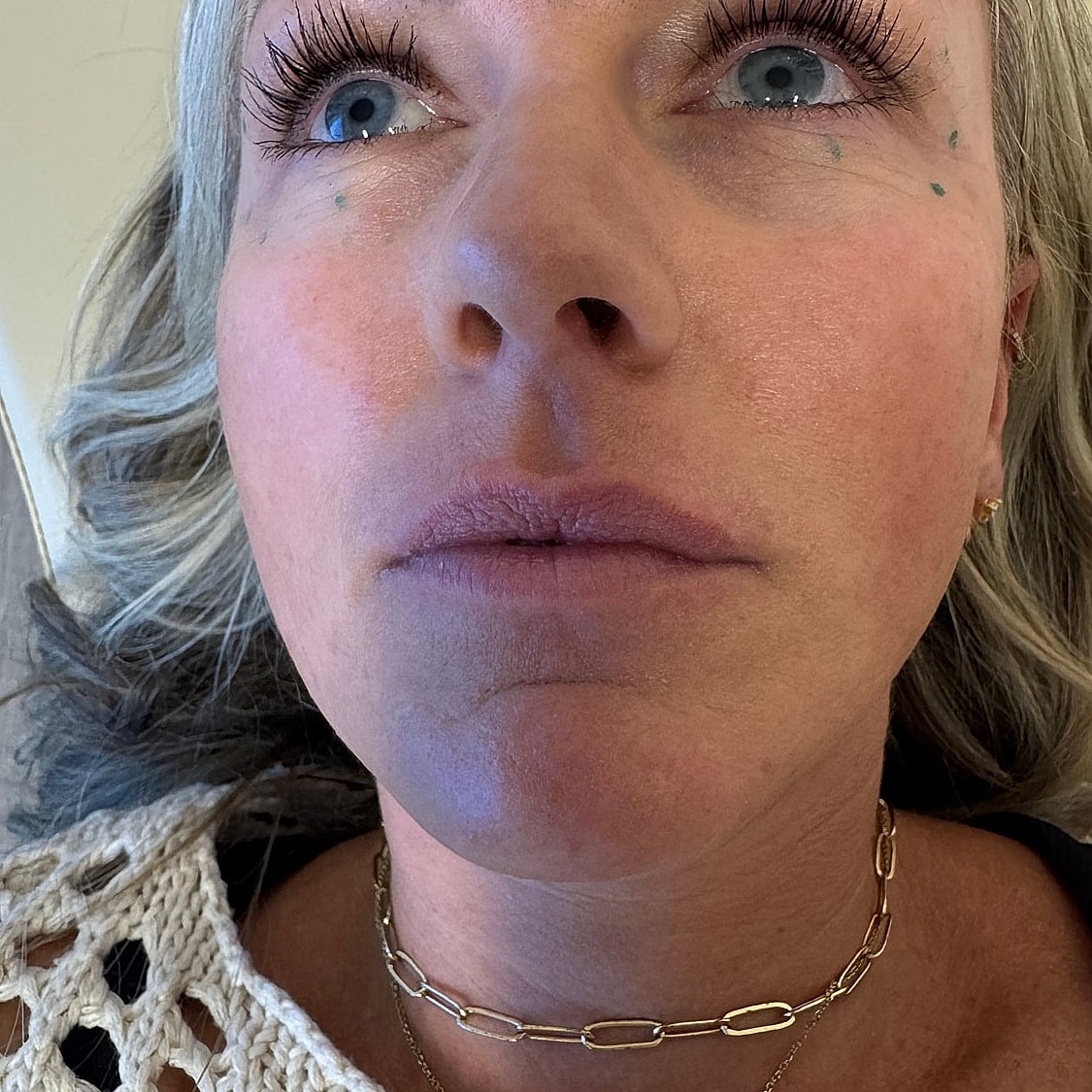 Lip Filler Before & After