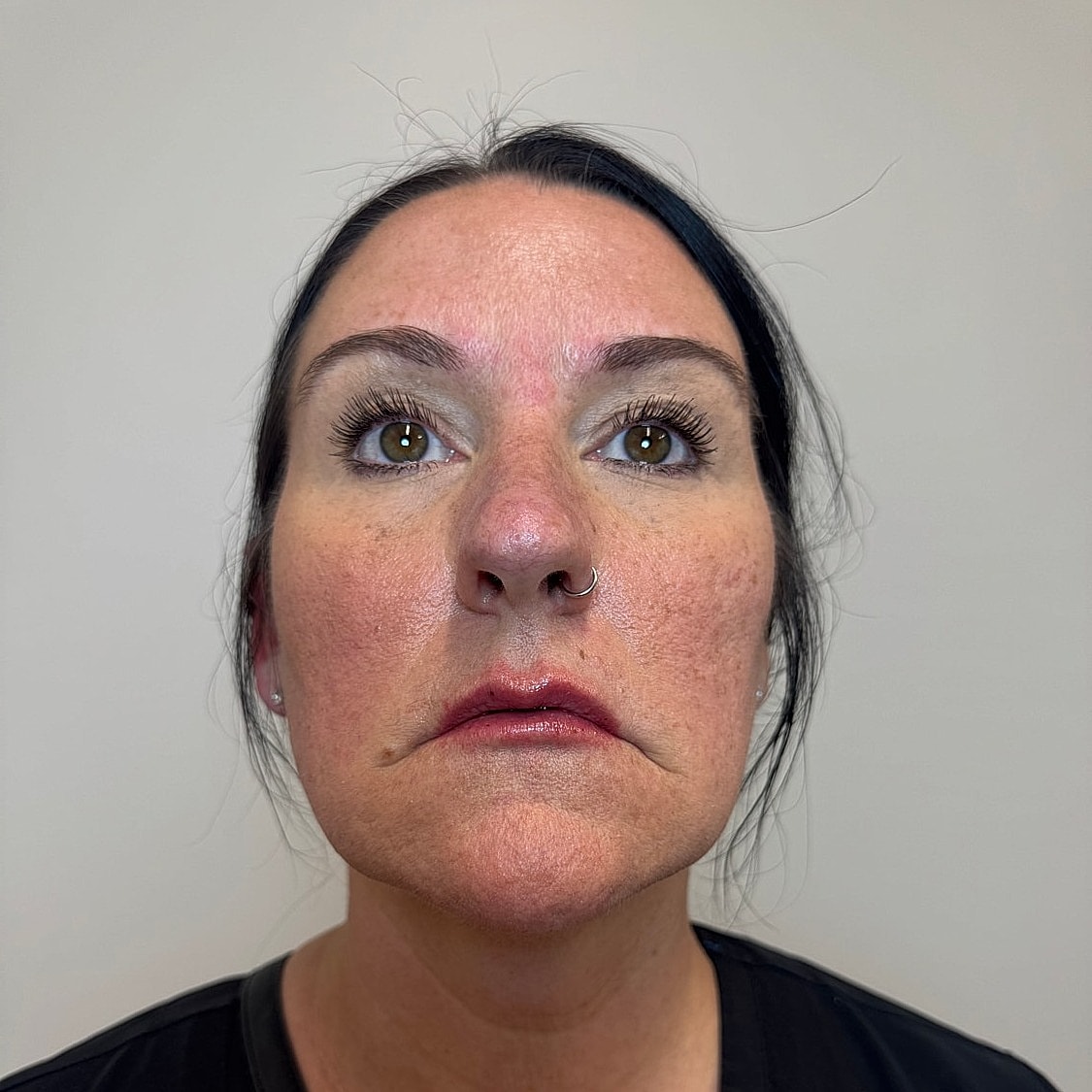 Lip Filler Before & After