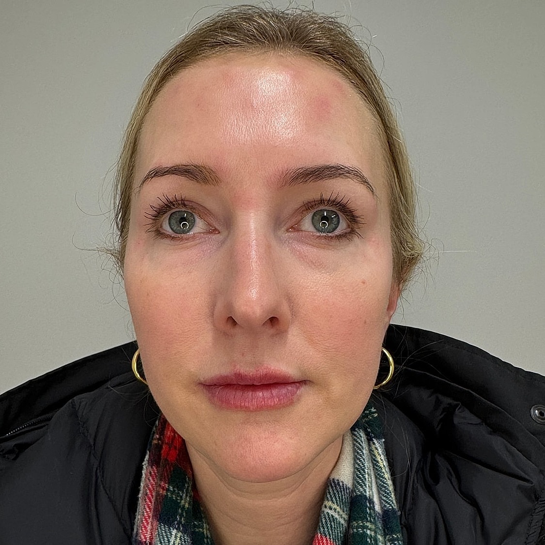 Lip Filler Before & After