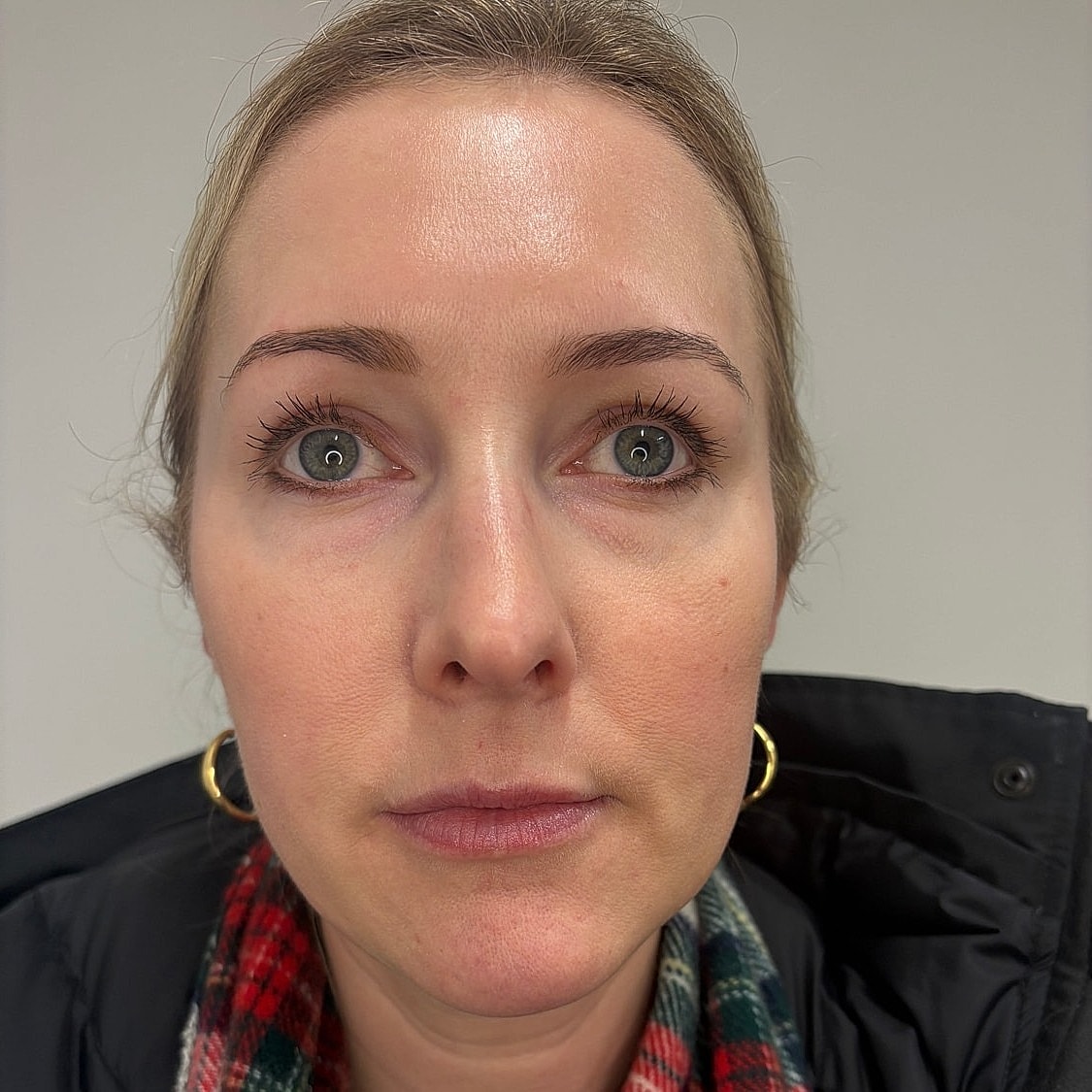 Lip Filler Before & After